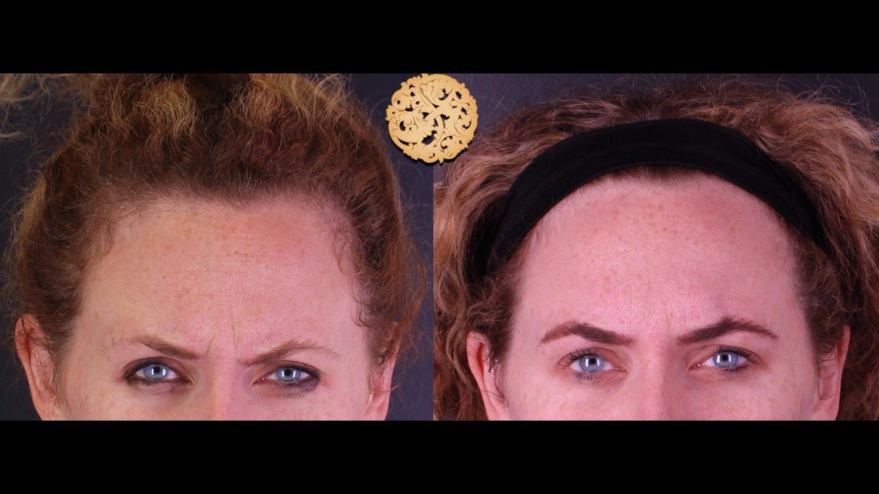 Botox Before & After