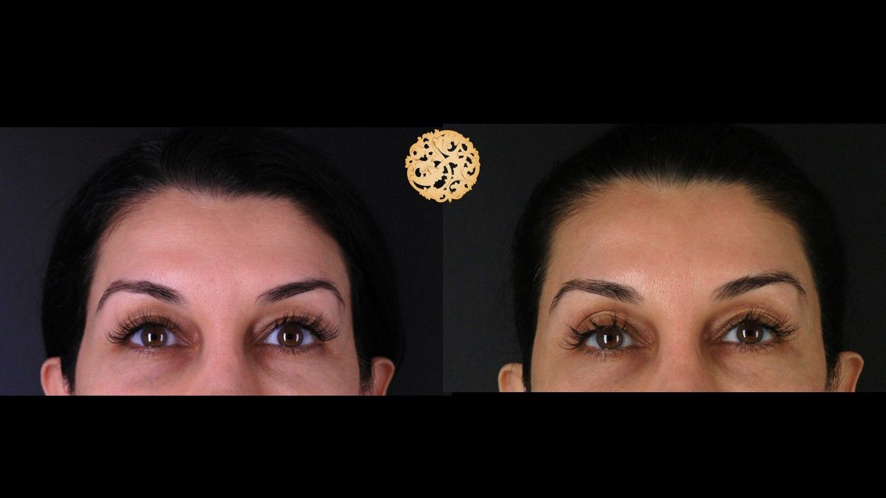 Botox Before & After