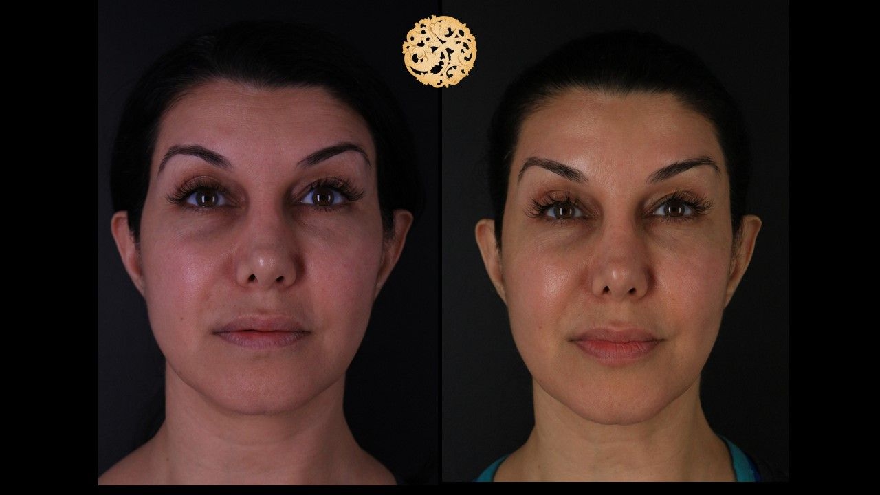 Botox Before & After