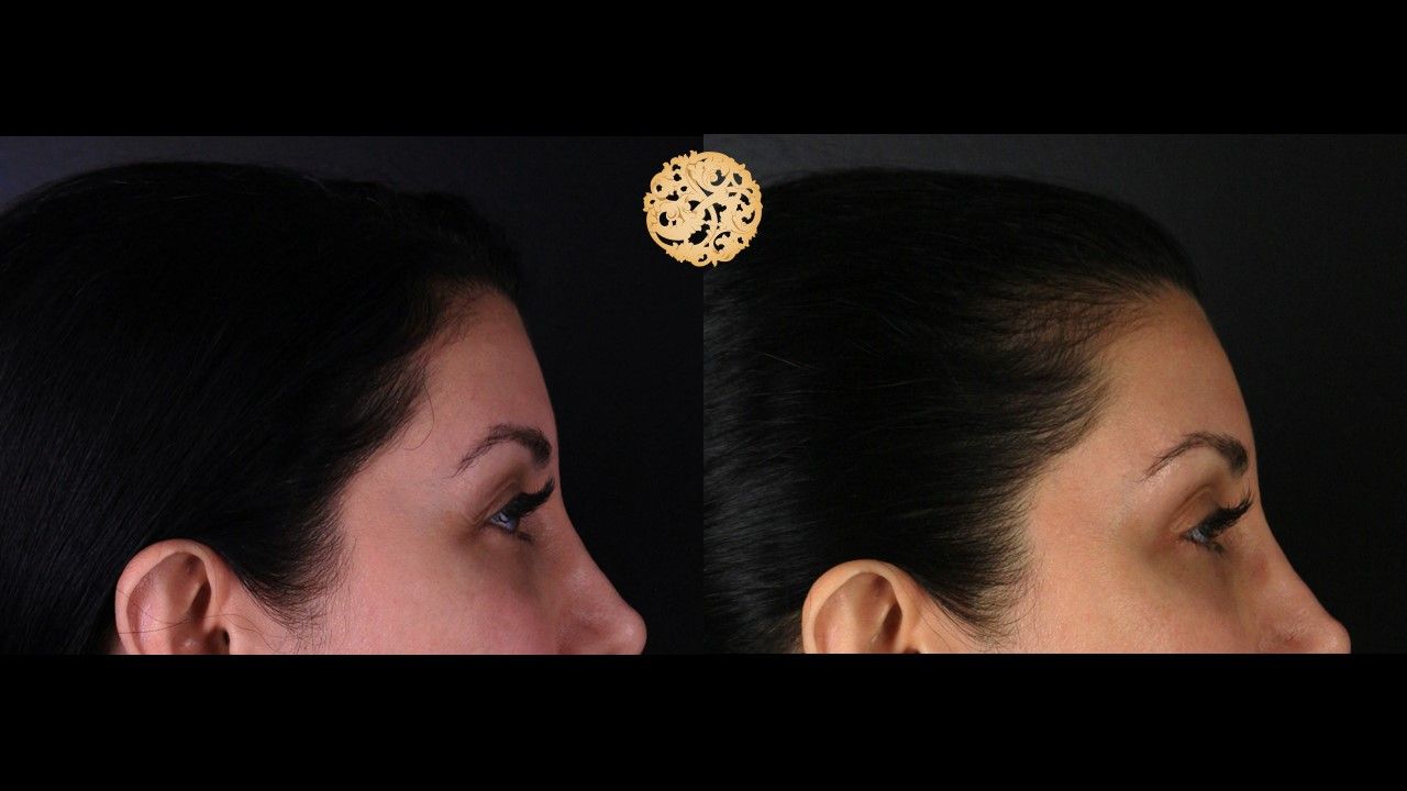 Botox Before & After