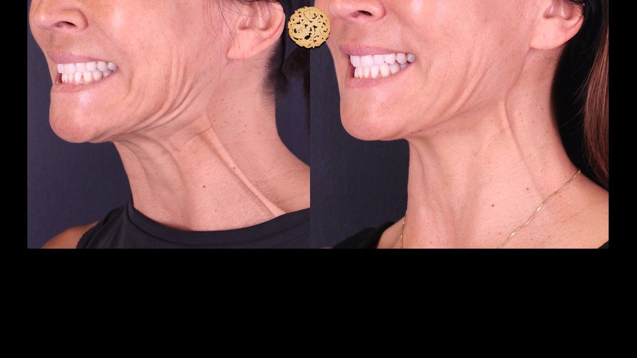 Botox Before & After