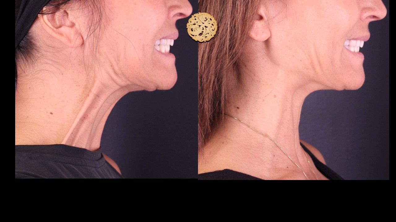 Botox Before & After