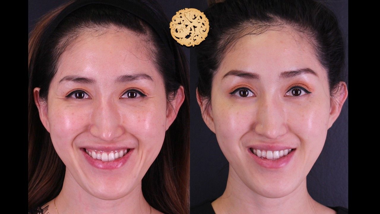 Botox Before & After