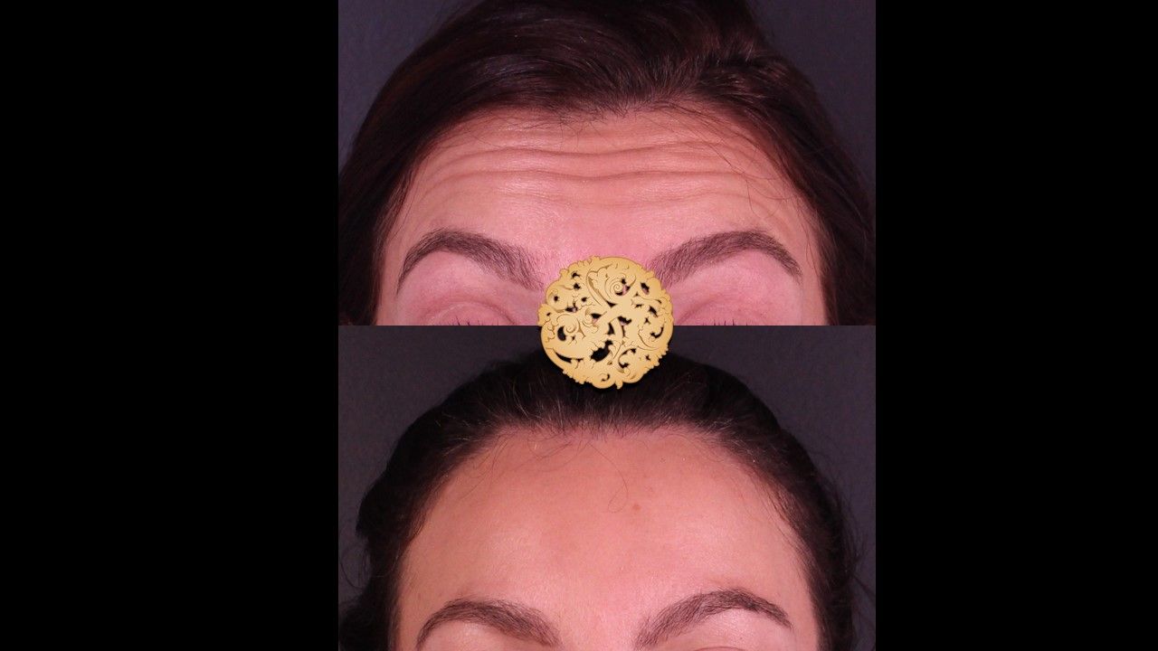 Botox Before & After