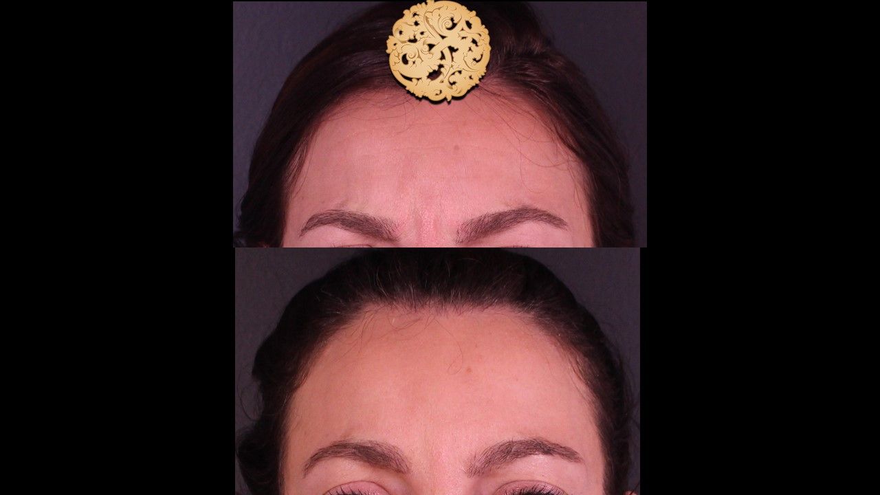 Botox Before & After