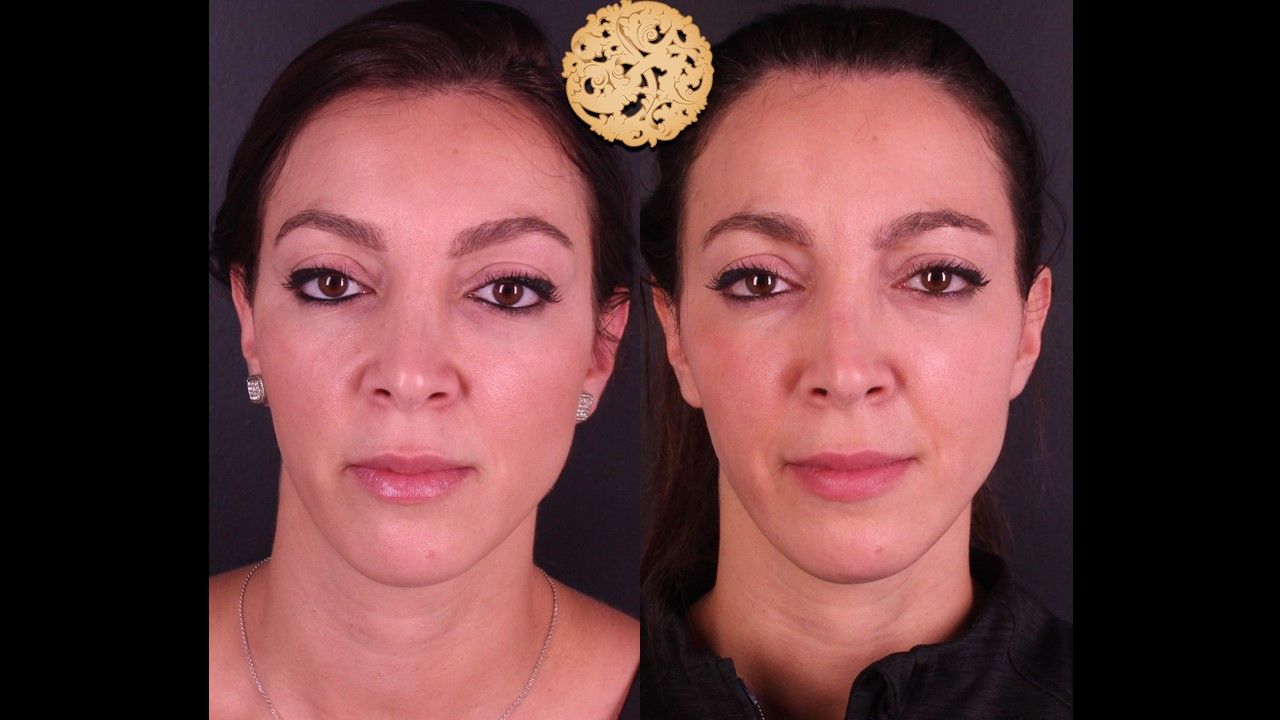 Botox Before & After