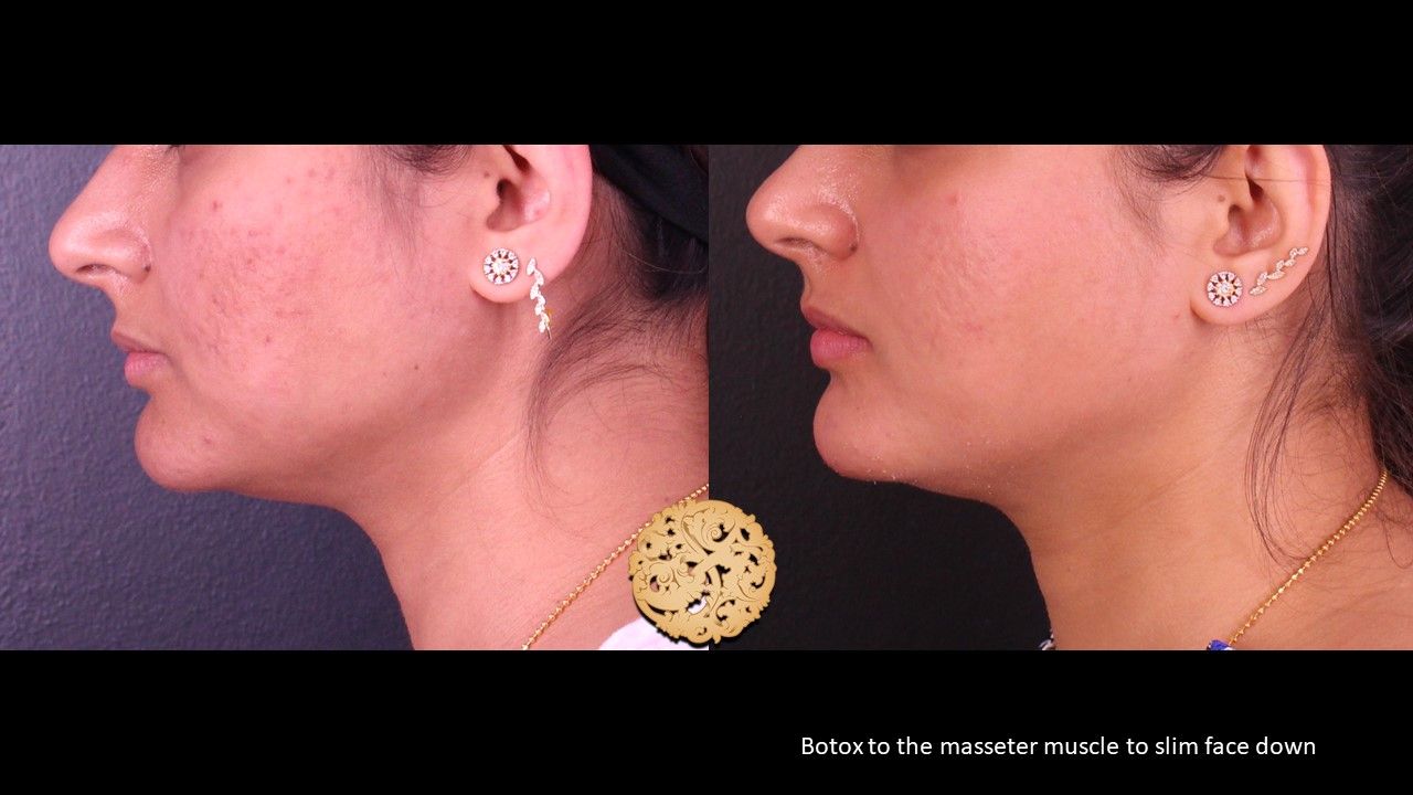 Botox Before & After