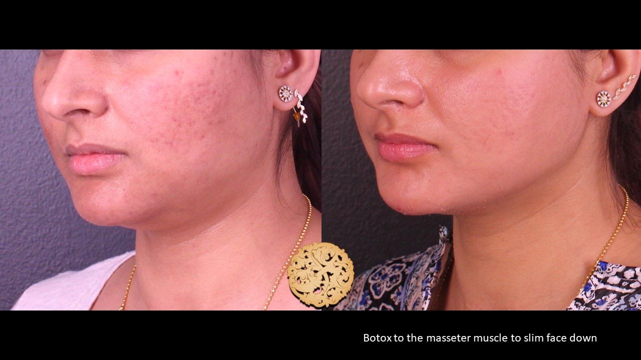 Botox Before & After