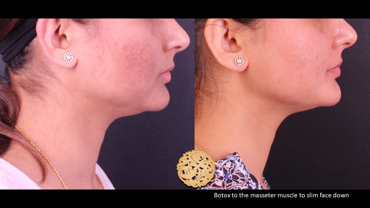 Botox Before & After