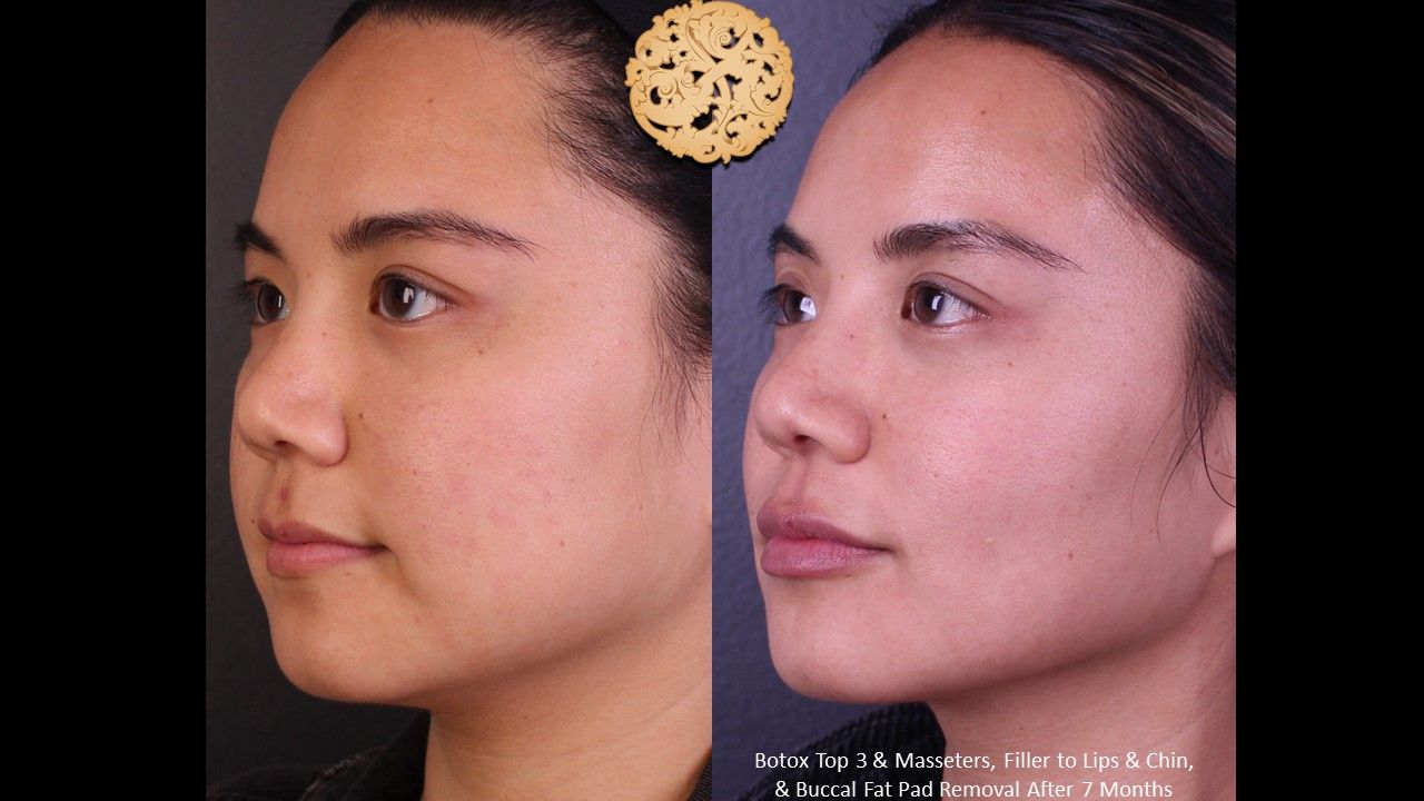 Botox Before & After