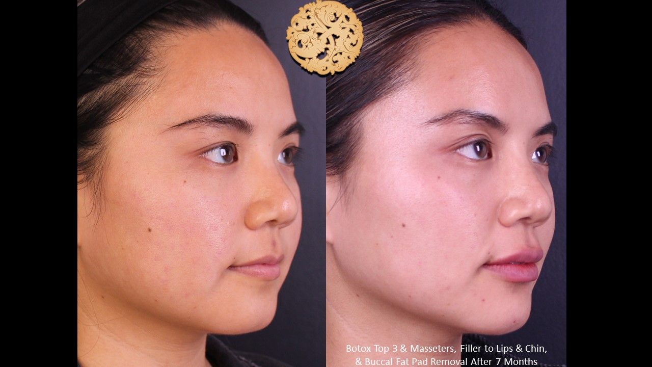 Botox Before & After