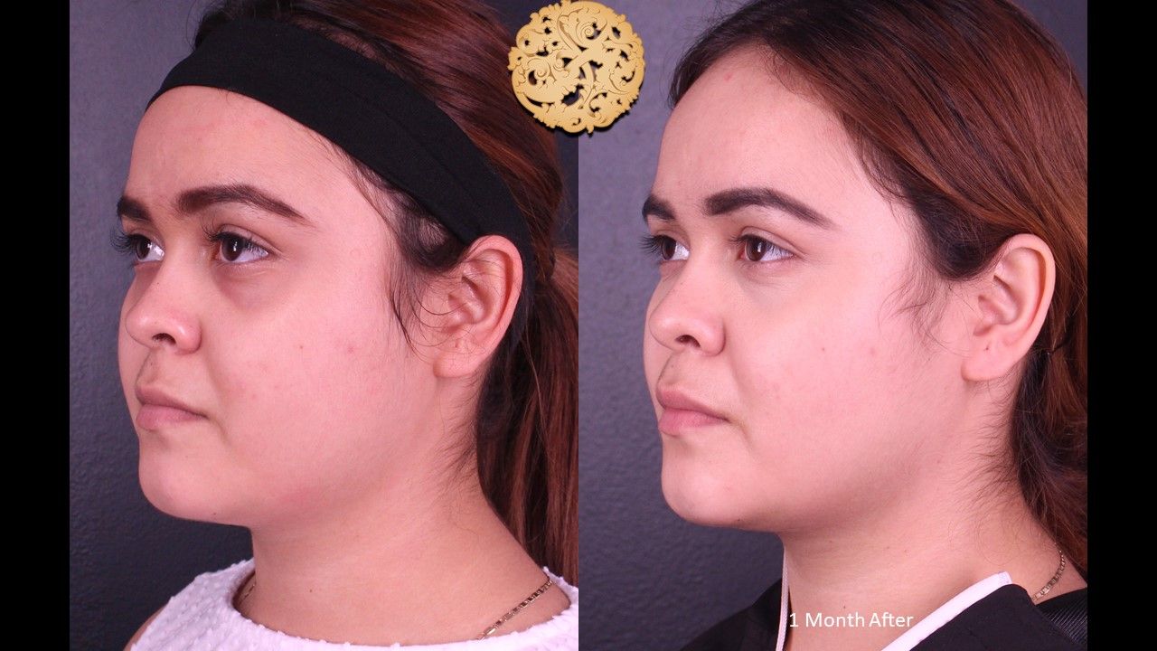 Botox Before & After