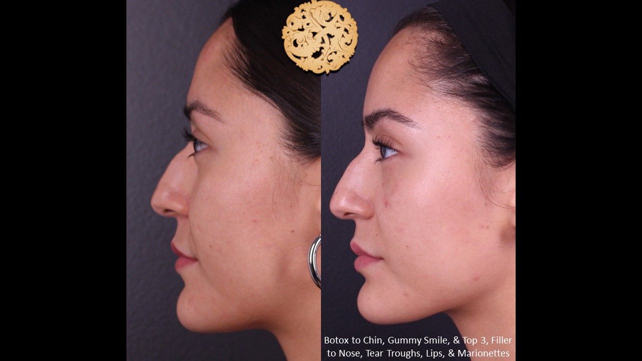 Botox Before & After