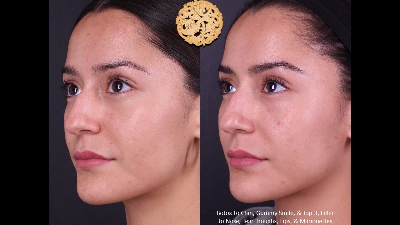 Botox Before & After