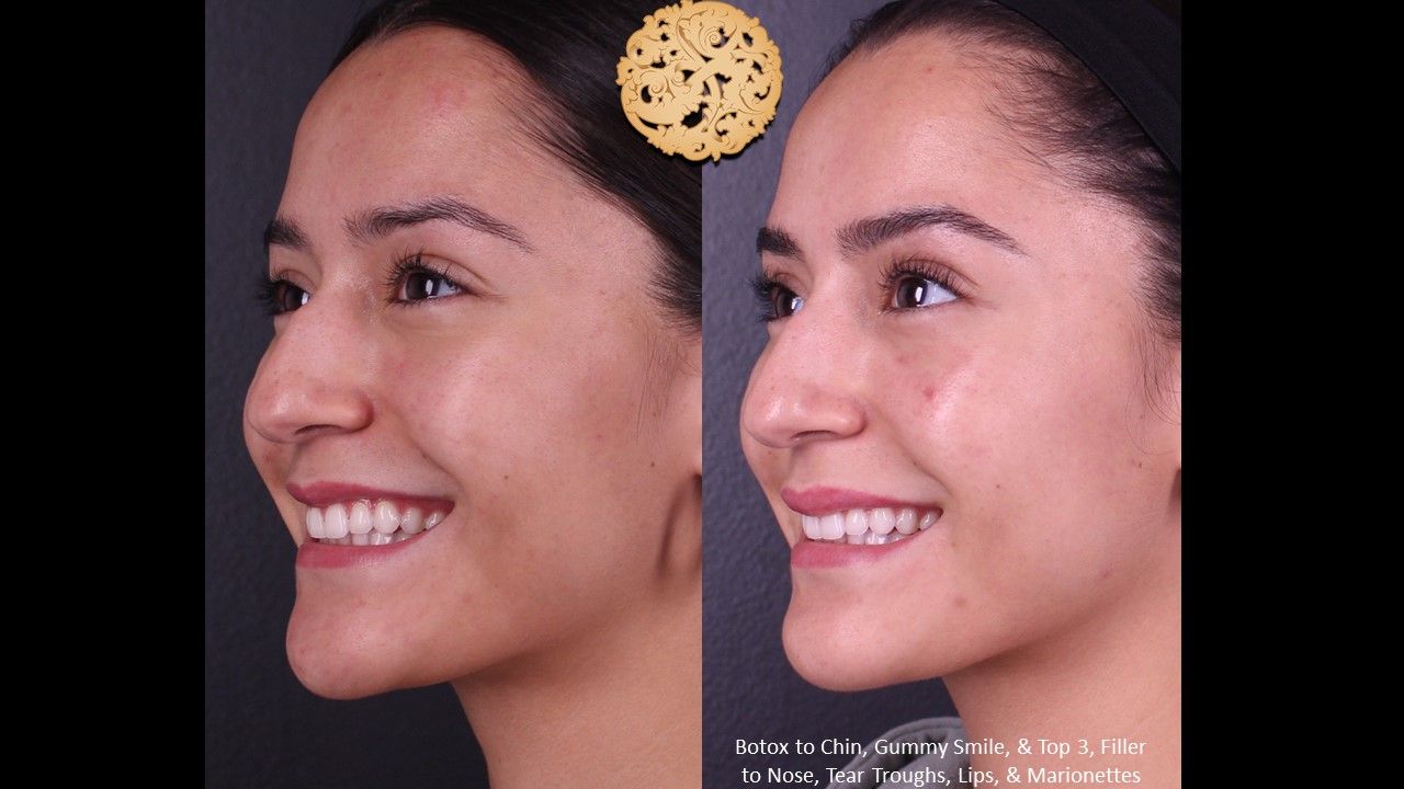 Botox Before & After