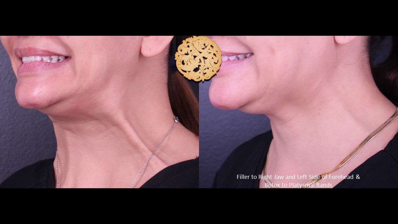 Botox Before & After