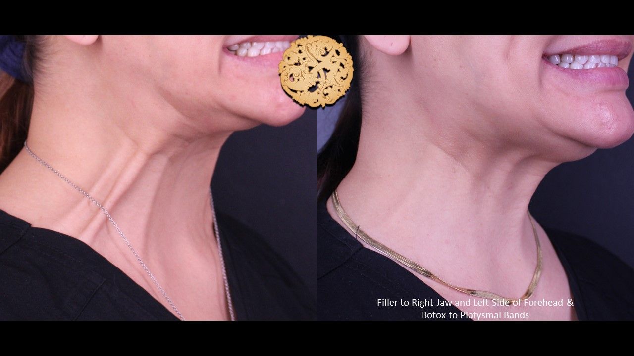 Botox Before & After