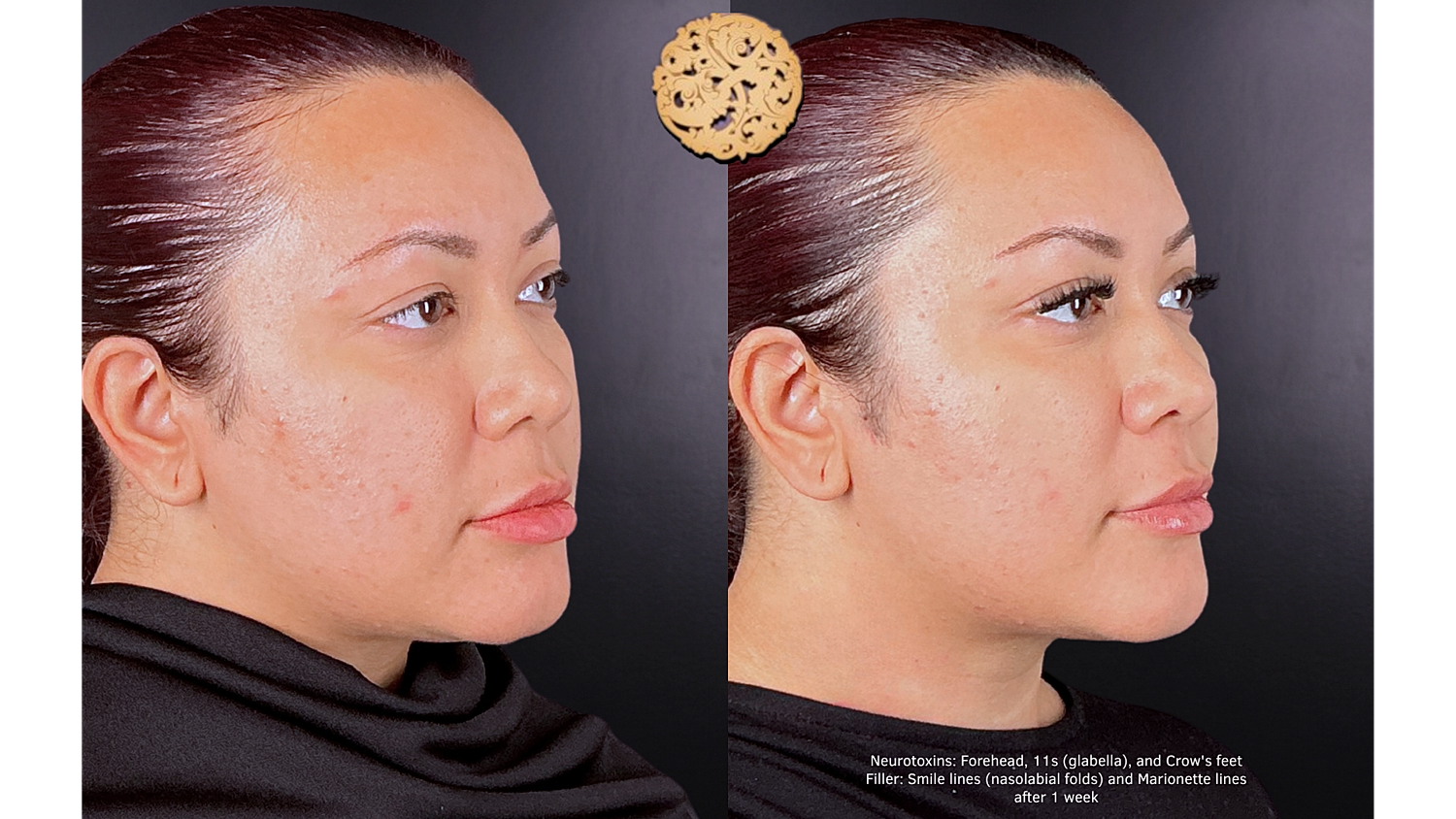 Botox Before & After