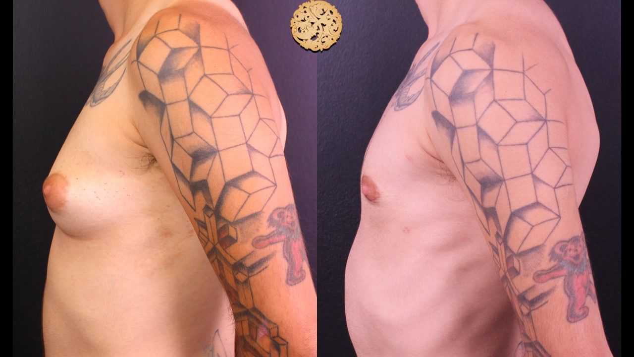 FTM Top Surgery Before & After