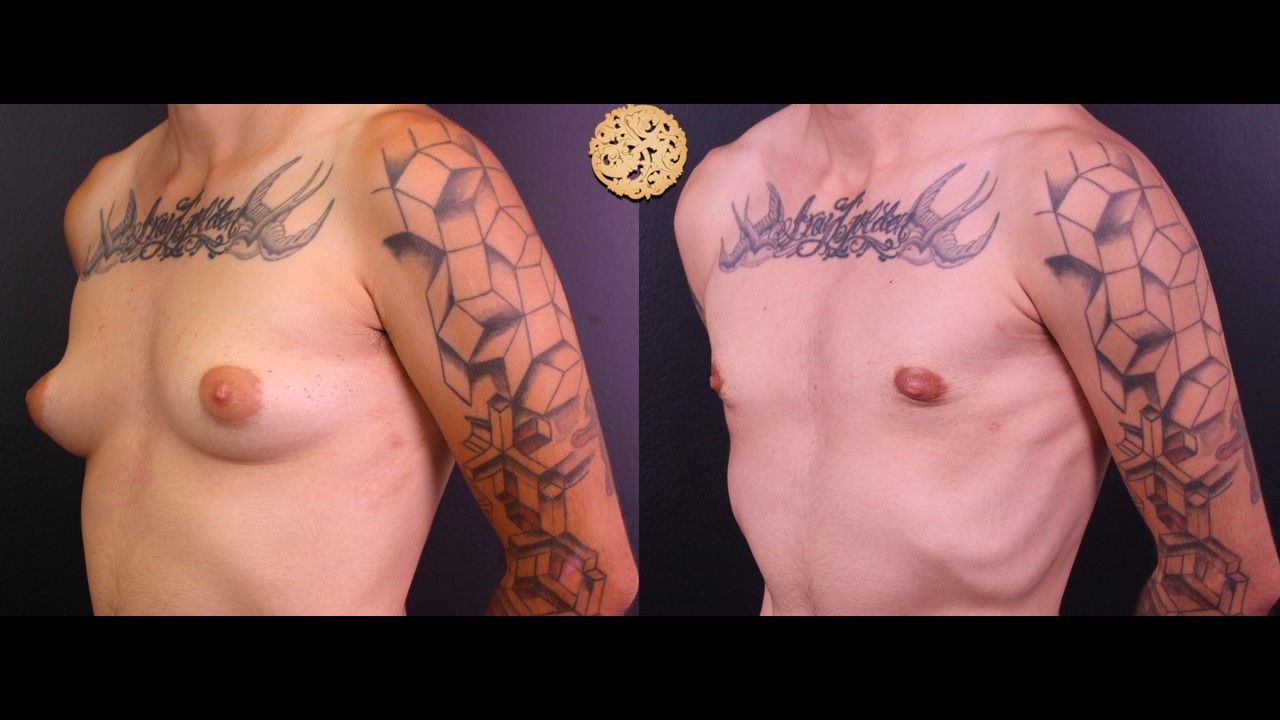 FTM Top Surgery Before & After