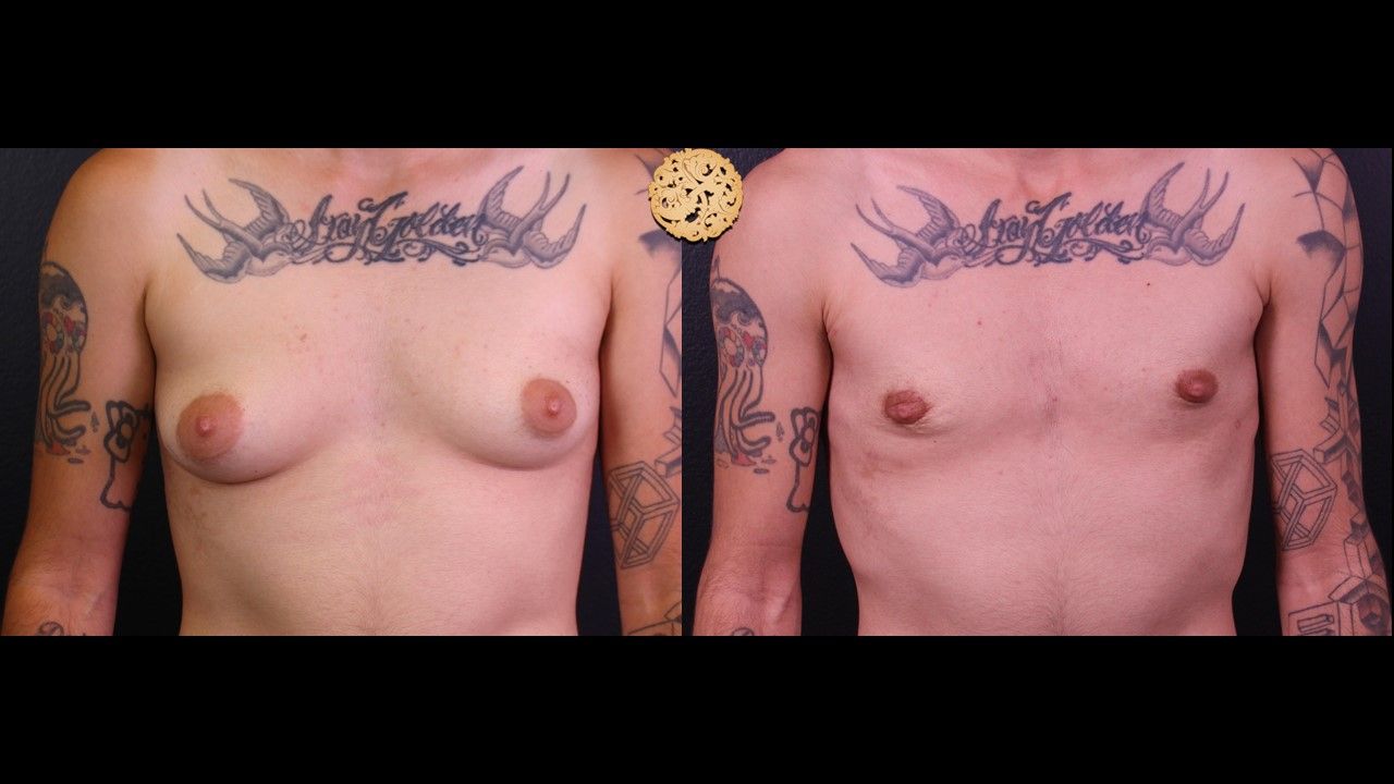 Ftm Top Surgery Before & After