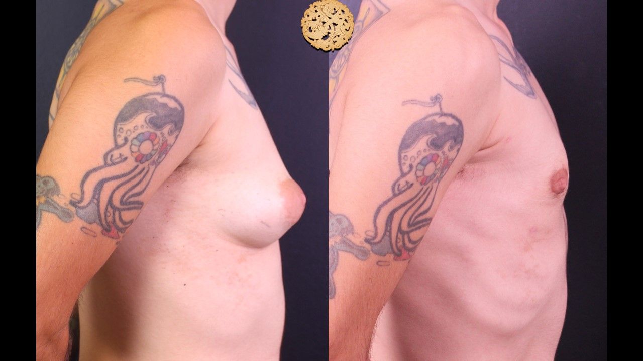 Ftm Top Surgery Before & After