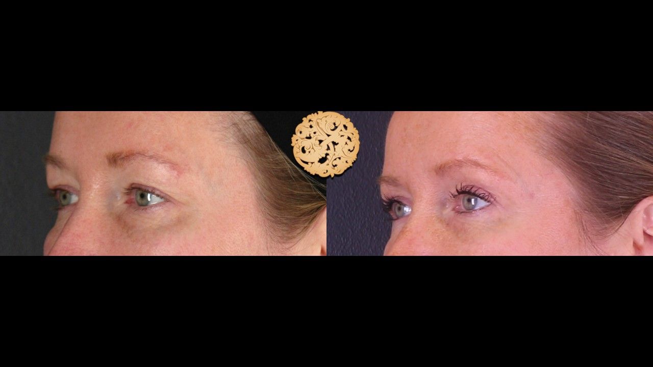 Upper Blepharoplasty Before & After