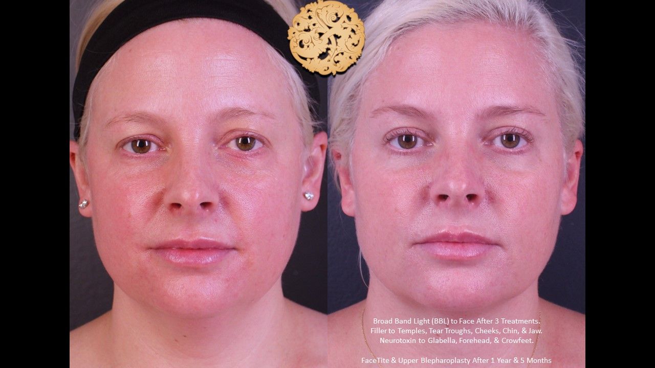 Upper Blepharoplasty Before & After