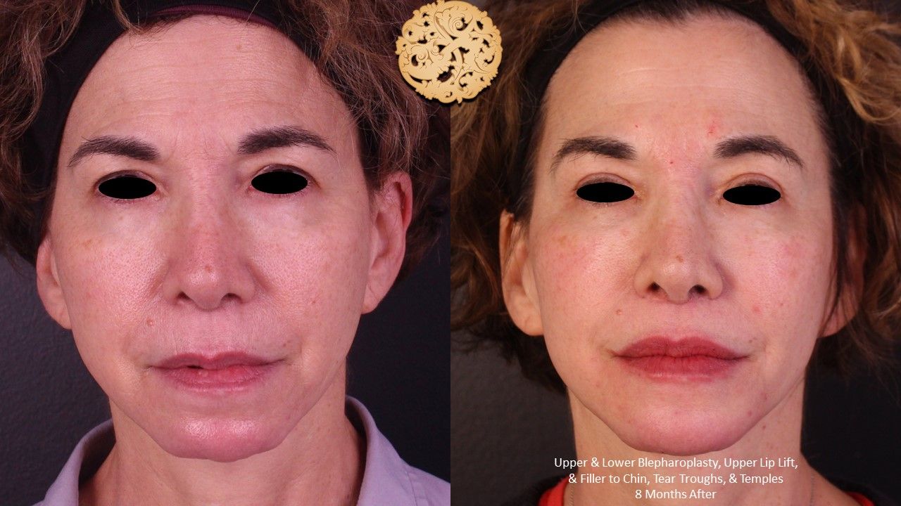Upper Blepharoplasty Before & After
