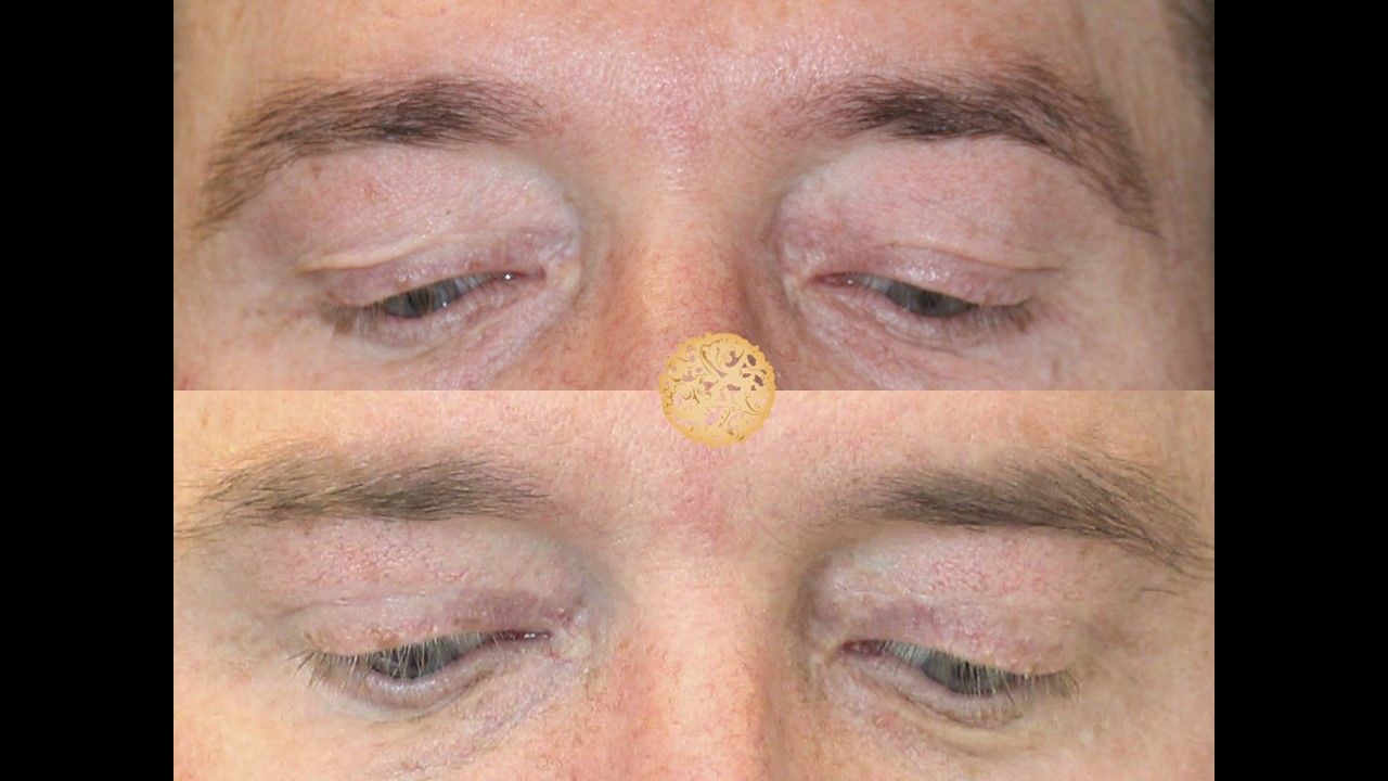 Upper Blepharoplasty Before & After