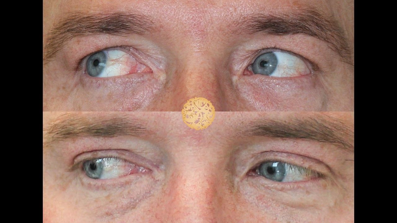 Upper Blepharoplasty Before & After