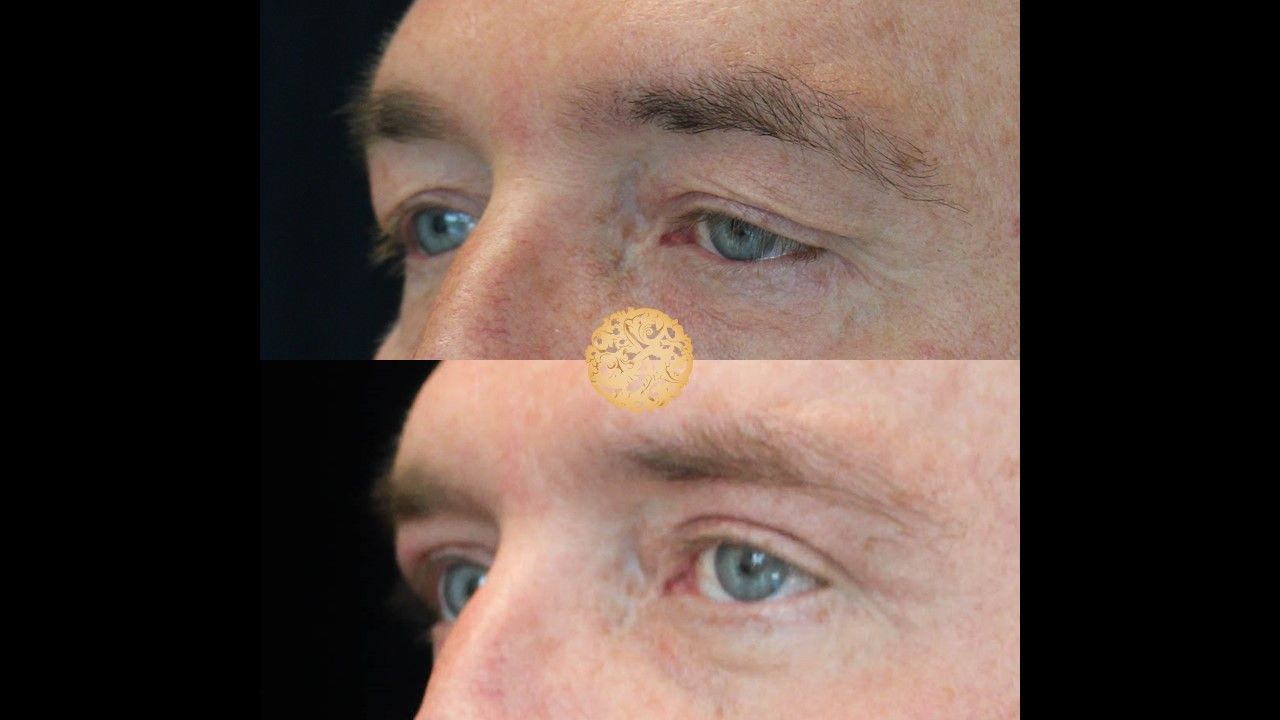 Upper Blepharoplasty Before & After