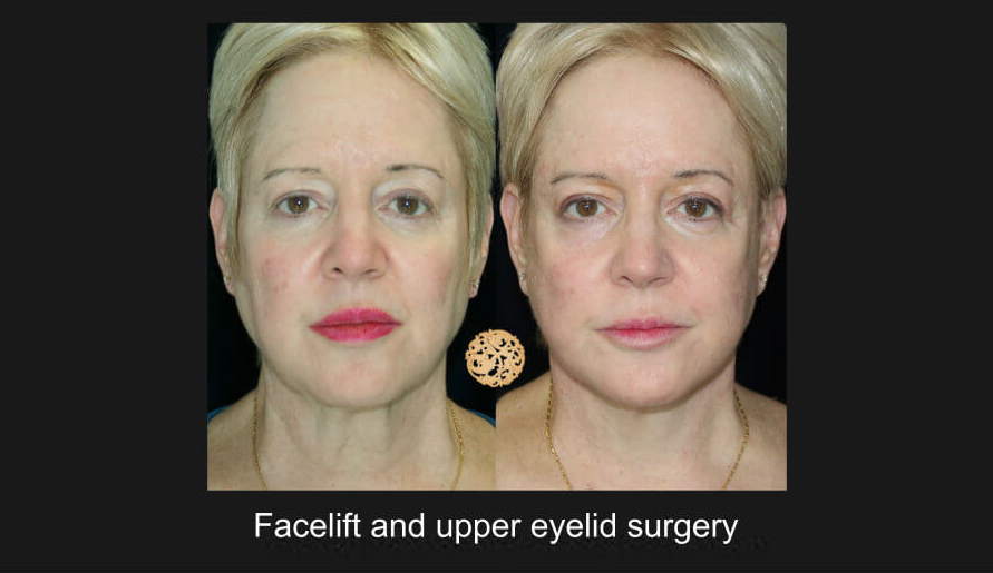Upper Blepharoplasty Before & After