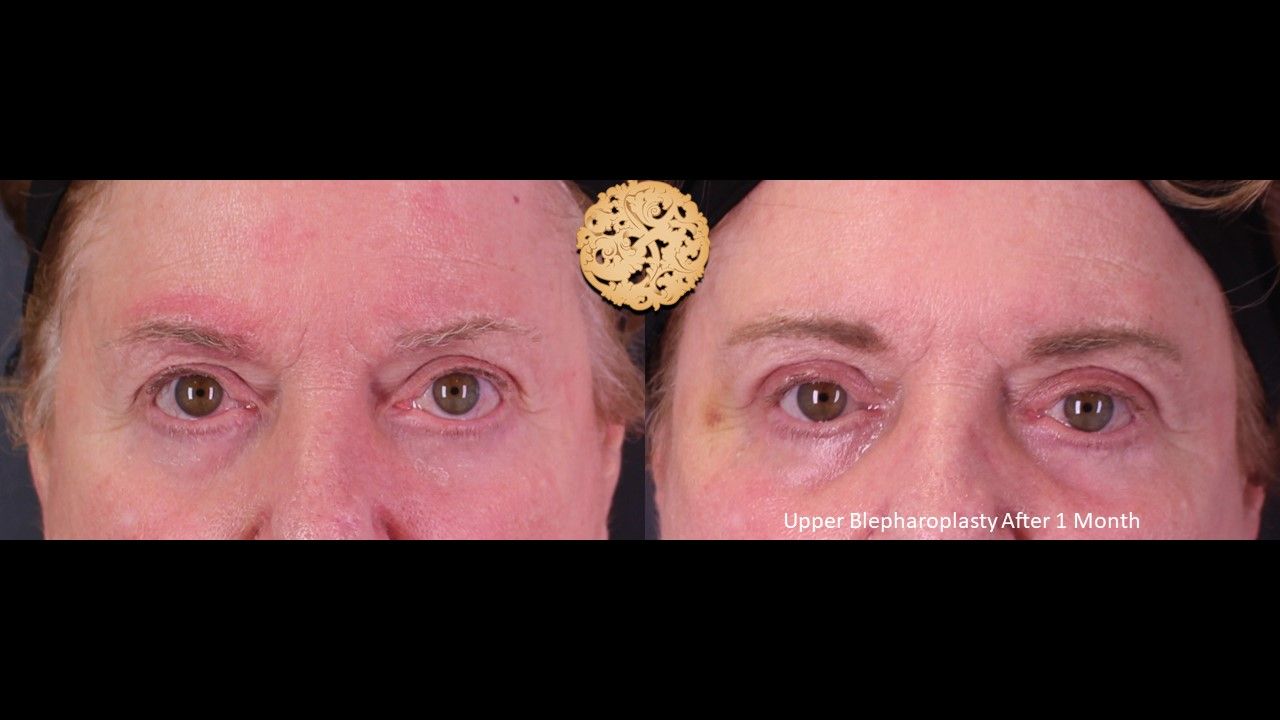 Upper Blepharoplasty Before & After