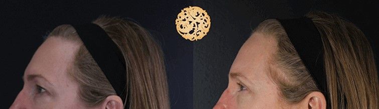 Upper Blepharoplasty Before & After