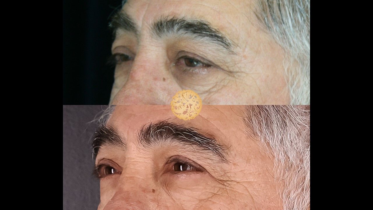 Upper Blepharoplasty Before & After