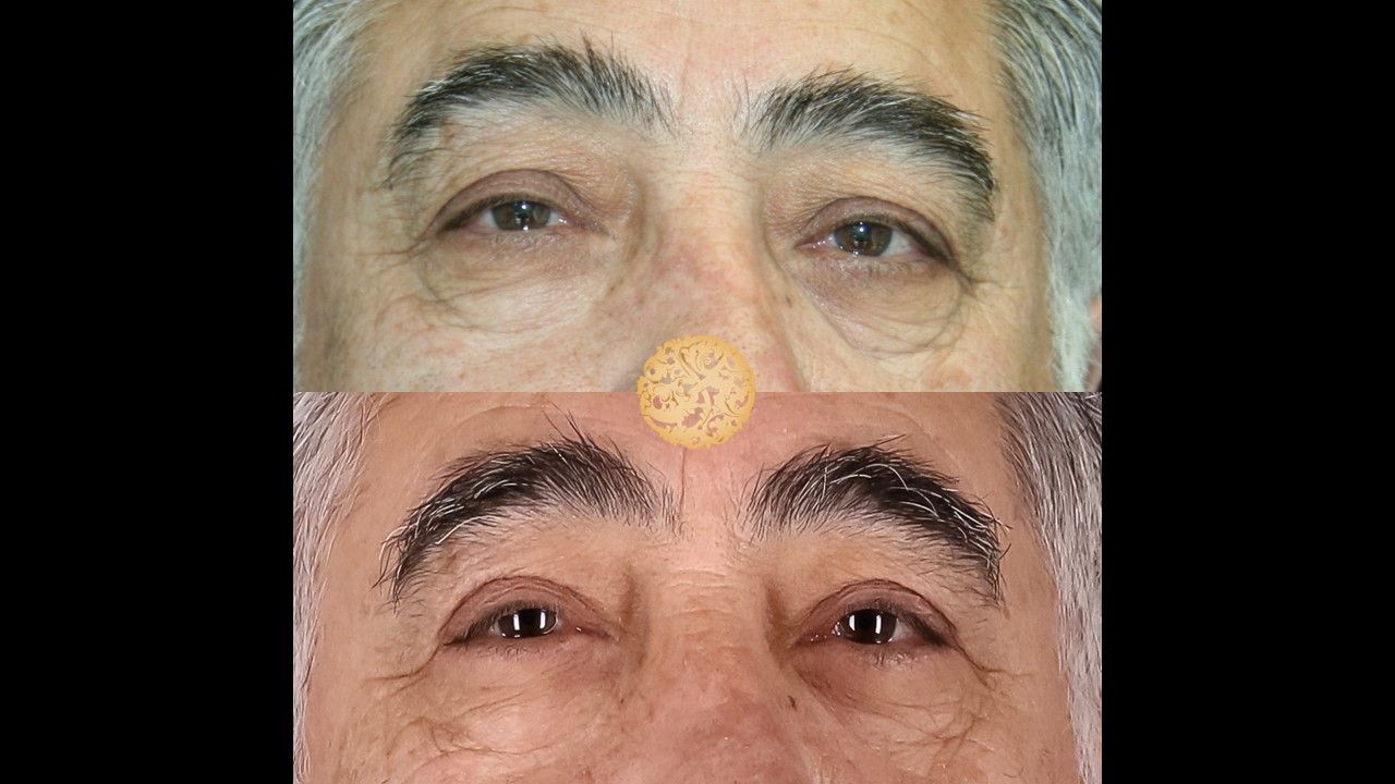 Upper Blepharoplasty Before & After