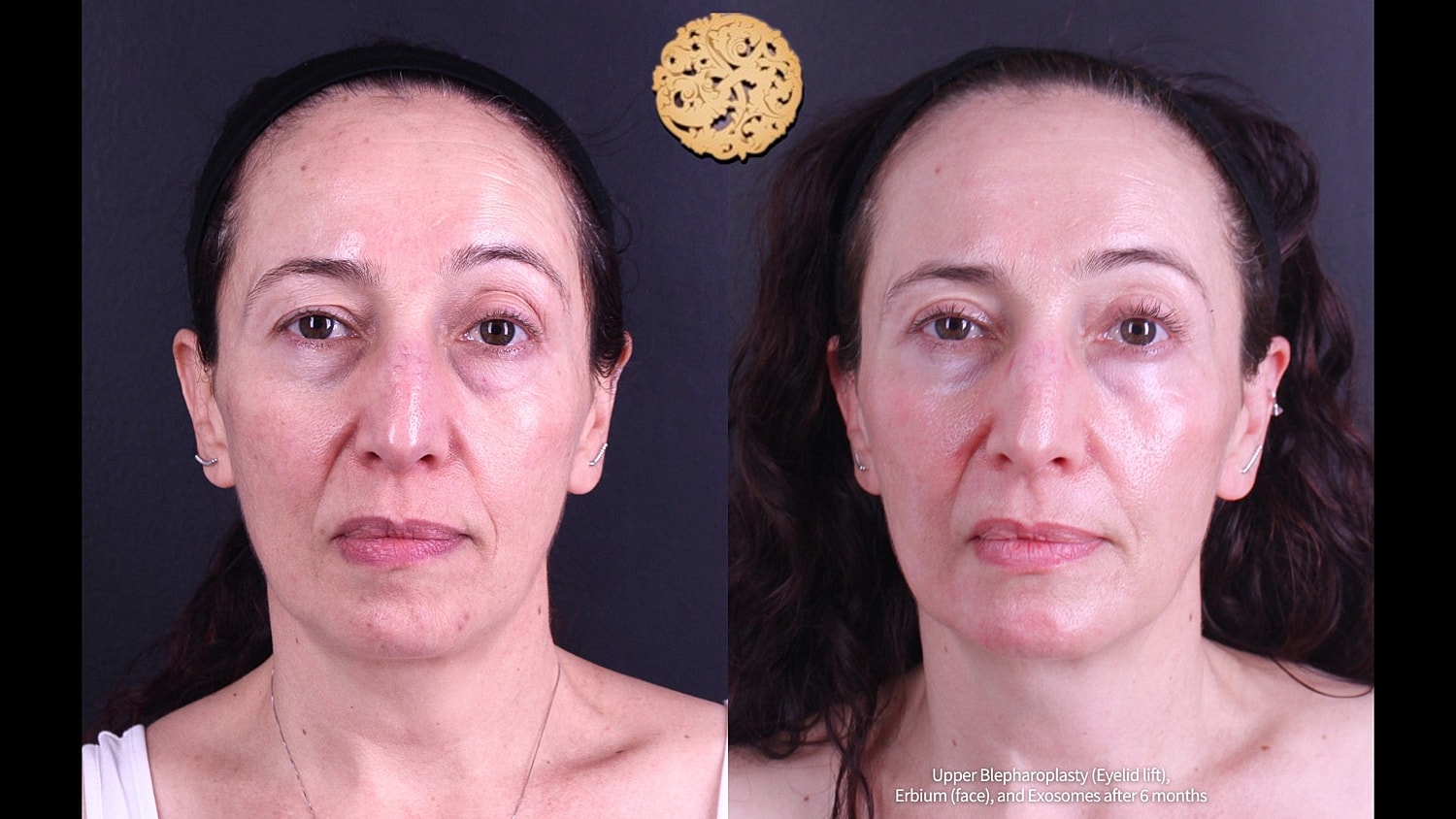 Upper Blepharoplasty Before & After
