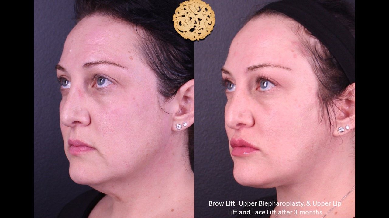 Upper Blepharoplasty Before & After