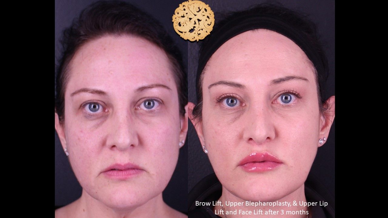 Upper Blepharoplasty Before & After