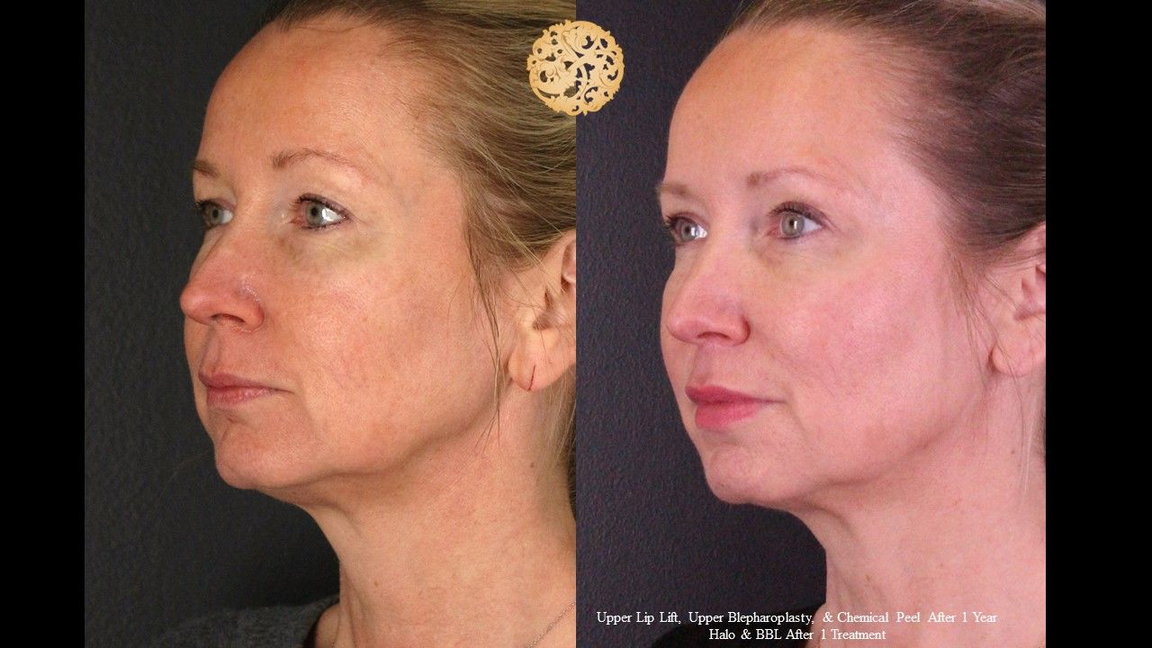 Upper Blepharoplasty Before & After