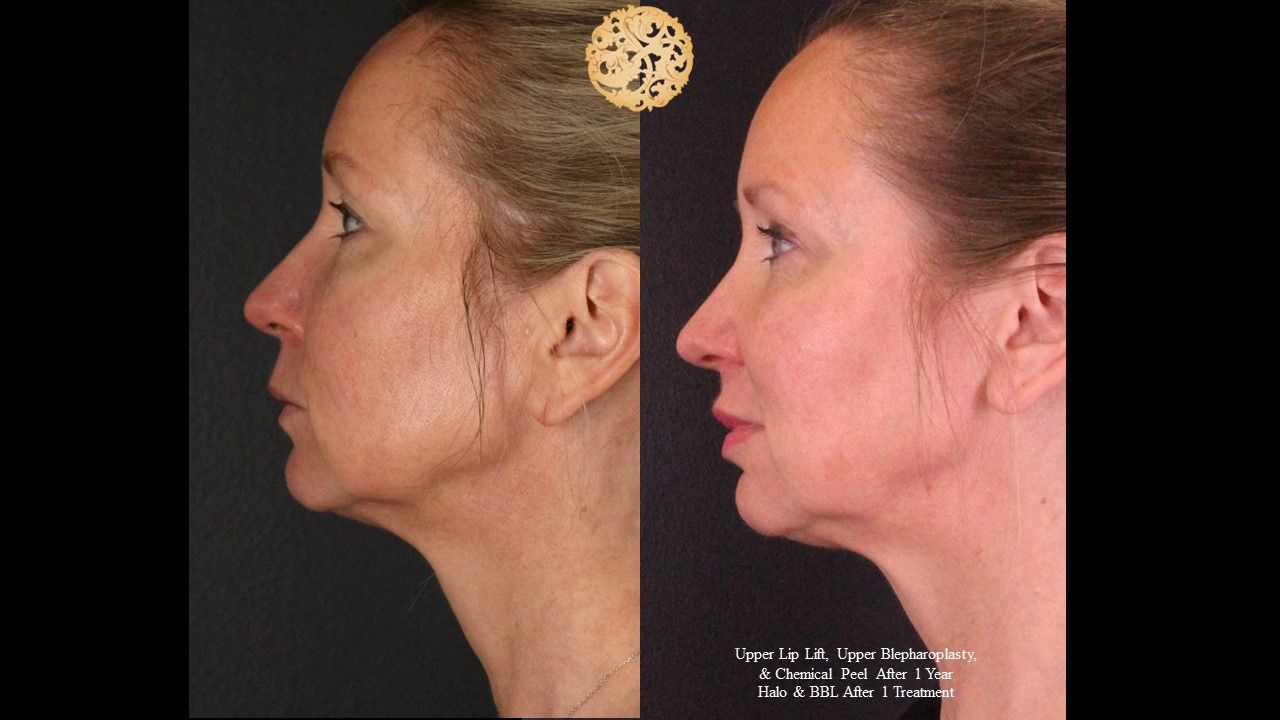 Upper Blepharoplasty Before & After