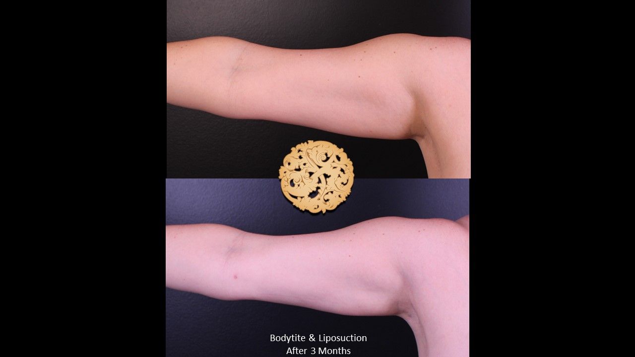Liposuction Arms Before & After