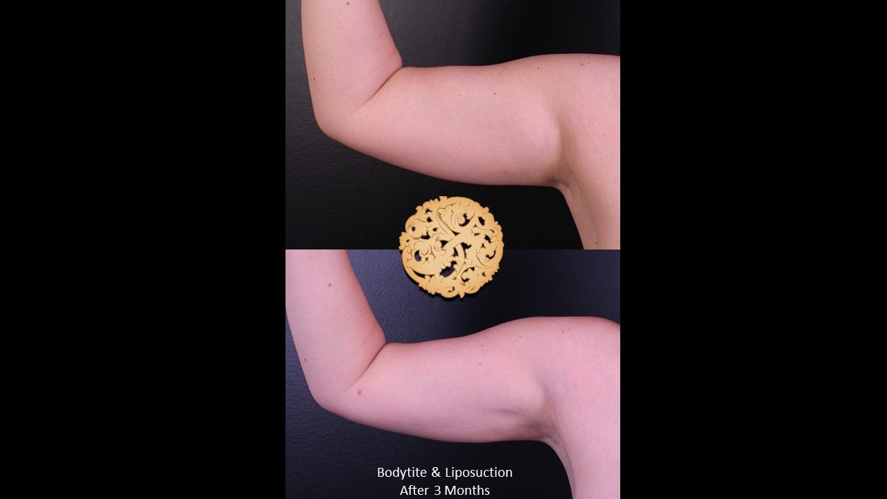 Liposuction Arms Before & After