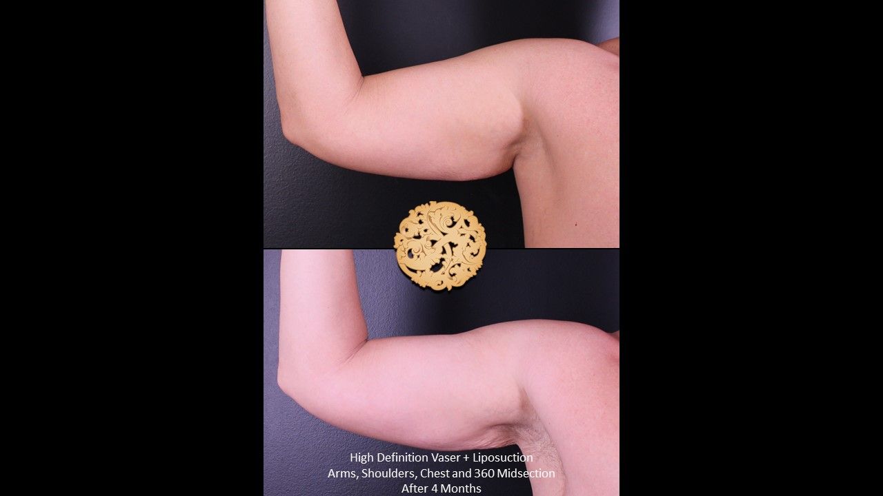 Liposuction Arms Before & After