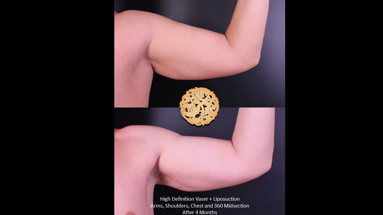 Liposuction Arms Before & After