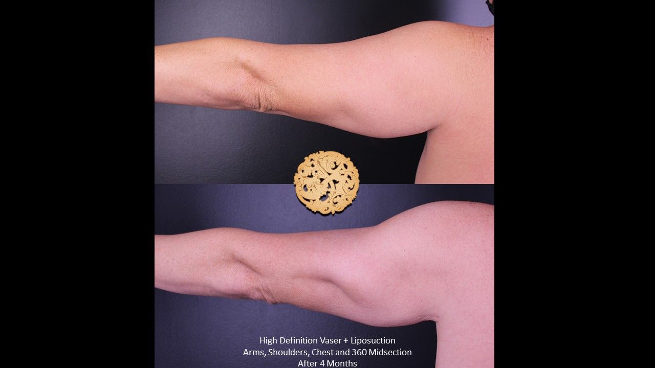 Liposuction Arms Before & After
