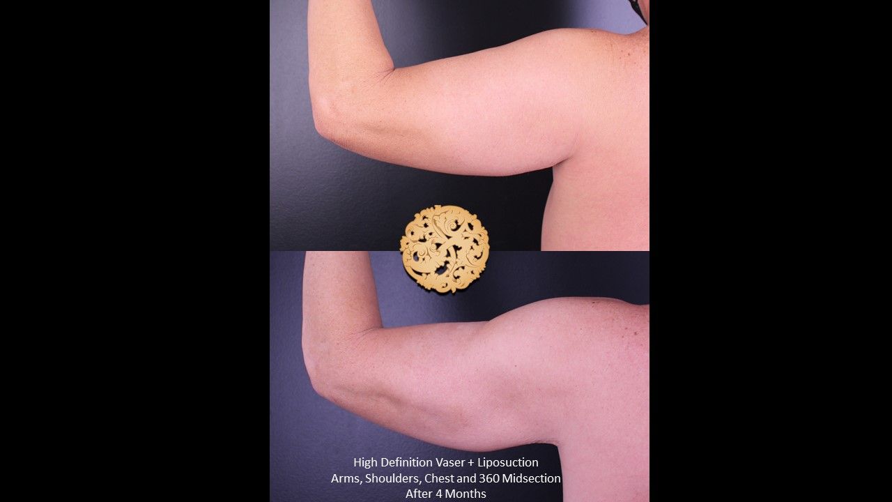 Liposuction Arms Before & After