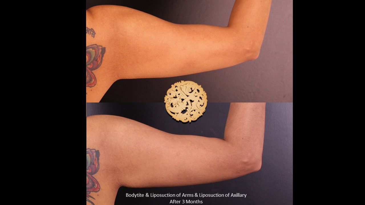 Liposuction Arms Before & After