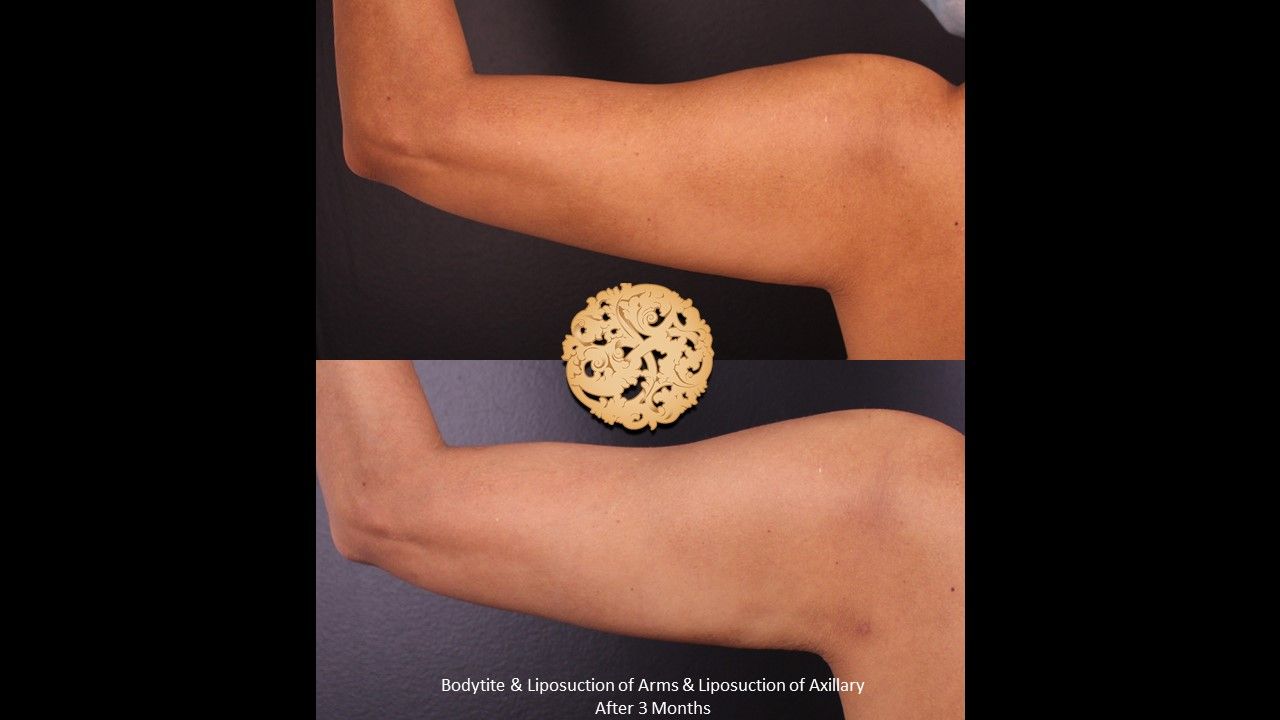 Liposuction Arms Before & After